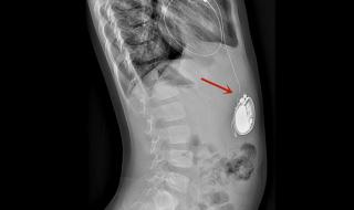男子植入最小人工心脏 男子植入最小人工心脏